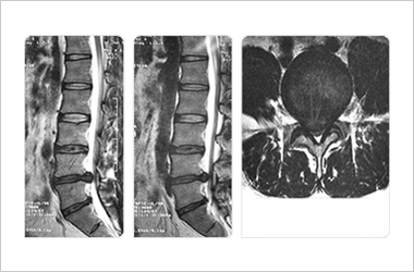 추간판 탈출증이 있는 환자의 MRI 사진