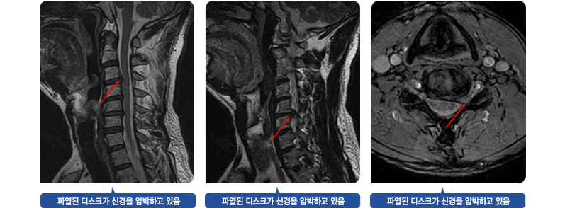 경추간판 탈출증이 있는 환자의 MRI