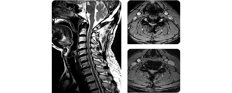 경추관 협착증이 있는 환자의 MRI