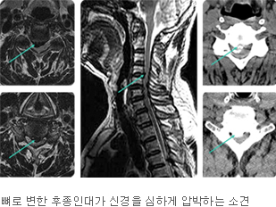 뼈로 변한 후종인대가 신경을 심하게 압박하는 소견