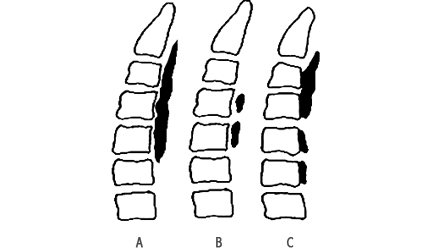 후종인대 골화증있는 경우를 가상한 모식도