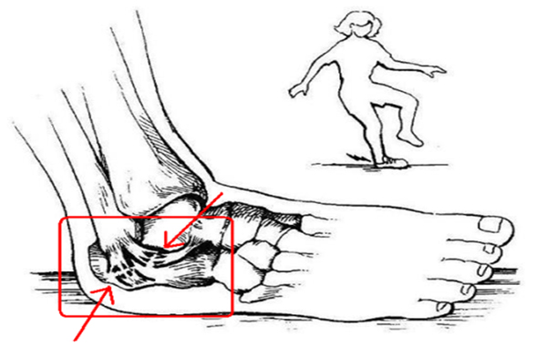 발목 인대 손상사진