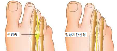 지간신경종과 정상자간신경 비교사진