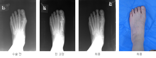 무지외반증 수술 전후사진