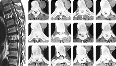 흉추부 후종인대 골화증이 있는 환자의 MRI 및 CT 소견