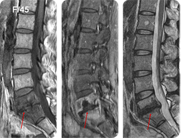 척추 결핵으로 진단된 환자의 MRI