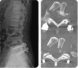 수술 후 x-ray 및 CT 