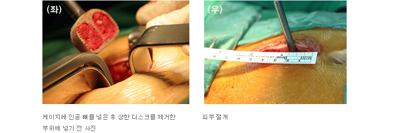 좌:케이지에 인공 뼈를 넣은 후 상한 디스크를 제거한 부위에 넣기 전 사진 우:피부 절개