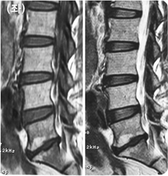 최소 침습 전방 유합술 후 x-ray 및 CT 소견