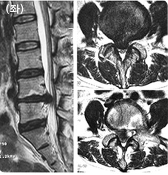 재발성 디스크로 요통 및 방사통이 심한 환자의 MRI사진