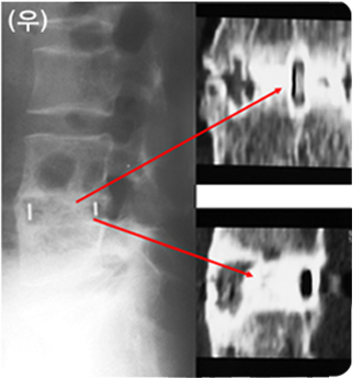 최소 침습 전방 유합술 후 x-ray 및 CT 소견