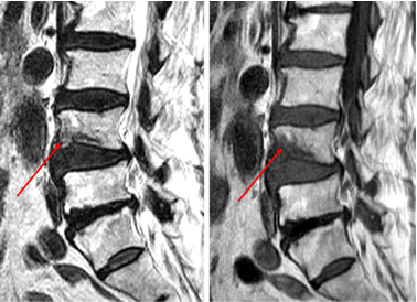 골다공증에 의한 압박골절이 있는 환자의 MRI