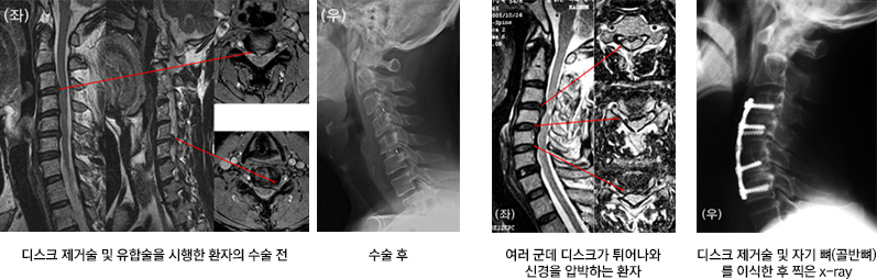 x-ray사진