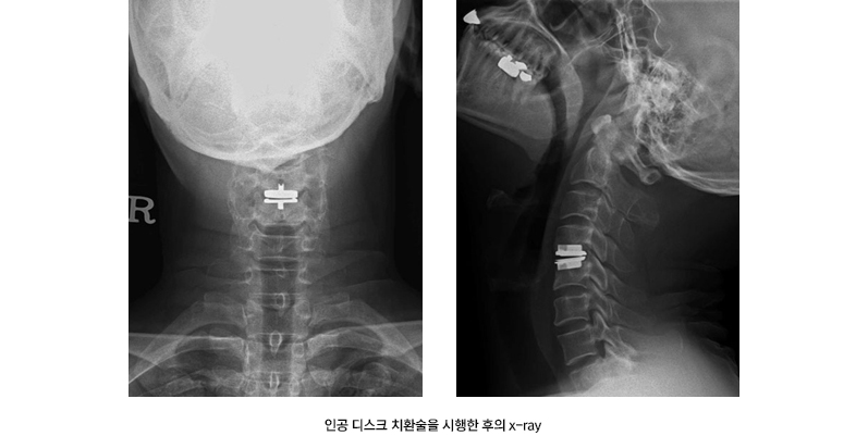 인공 디스크 치환술을 시행한 후의 x-ray